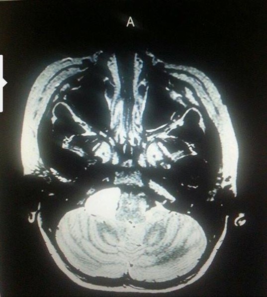 Diegel brain scan