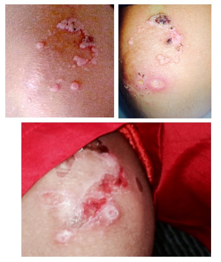 skin-infection-HPV-warts