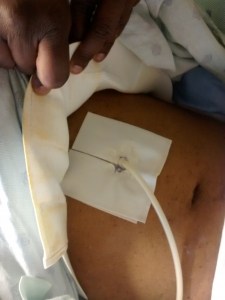 Julius Corley feeding tube