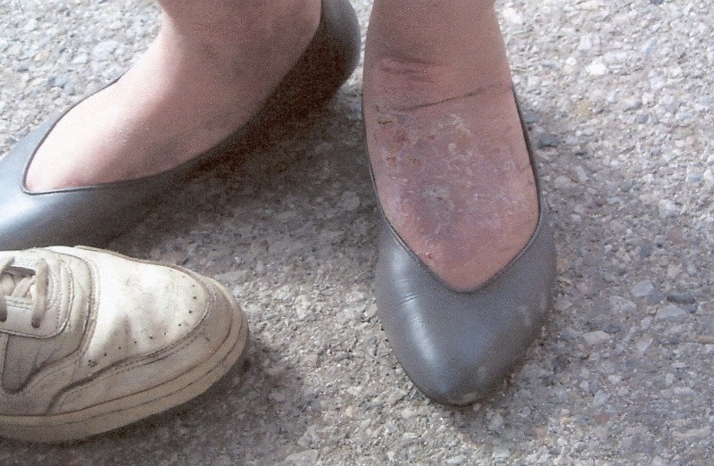 Nancy's healed up foot