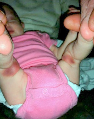 Parents show that Leigh Ann's bruises match position of car-seat buckle, and don't understand why their attorney won't consider it as an explanation. Photo provided by family.