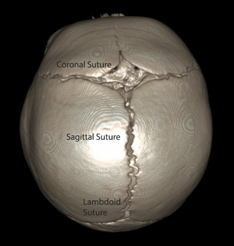 Braxton contrast normal skull CT scan