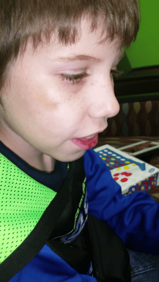 Headley Conner black eye