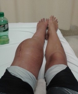 Byler leg before amputation via Elizabeth