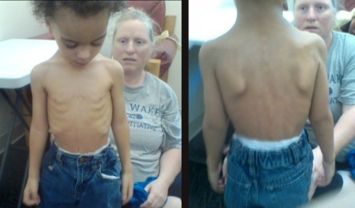 Malakai-skin-and-bones-photos