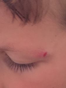 Whitney Ethyn gash over eye in foster care