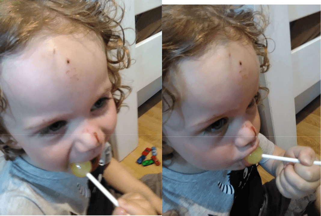 Skyler With Smashed In Face After Having Escaped The Foyer and Running Away - Not Taken To Doctor