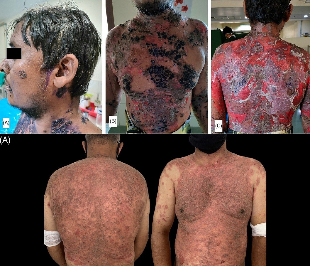 skin-diseases-after-COVID-vaccines